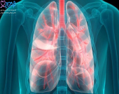  علائم سرطان ریه چیست و چه درمانی دارد؟