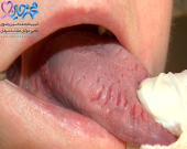  سرطان زبان چه نشانه هایی دارد؟