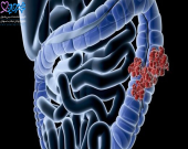 سرطان روده در جوانان چه علائمی دارد؟