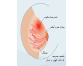 علائم سرطان سینه در شیردهی