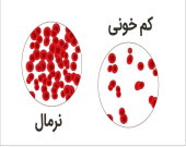 ده علامت شایع کم خونی کدام است؟ 