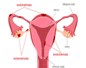 علائم آندومتریوز از درد لگن تا ناباروری
