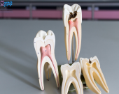 آیا درمان ریشه دندان باعث سرطان می شود؟