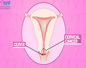  شیمی درمانی سرطان سرویکس