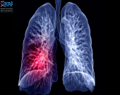 عوامل خطر سرطان ریه را بشناسید