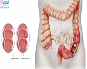 علائم اولیه سرطان روده در زنان